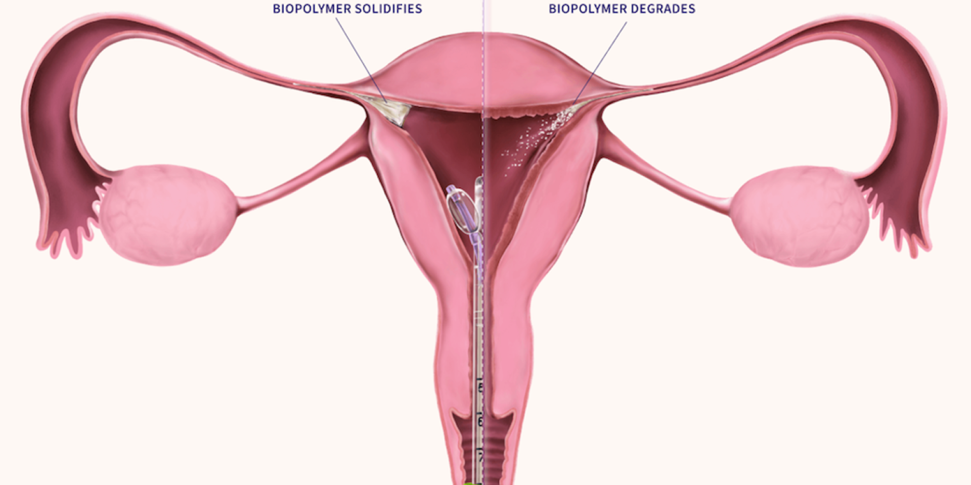 Illustration of the internal female reproductive system with a new device inserted that performs a procedure to block the fallopian tubes