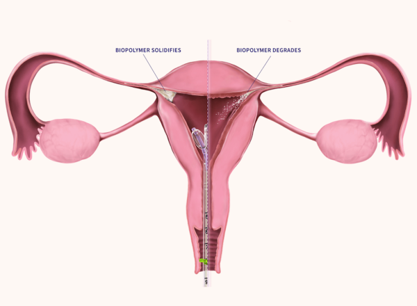 Illustration of the internal female reproductive system with a new device inserted that performs a procedure to block the fallopian tubes